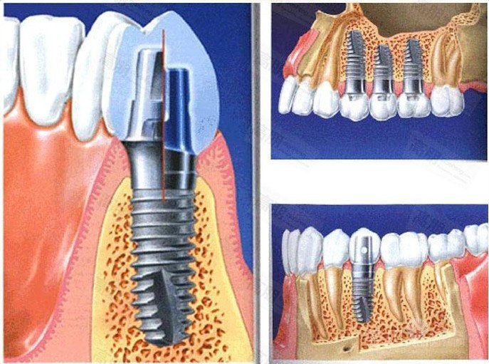 赖红昌教授，详细介绍种植牙手术真的安全无痛吗