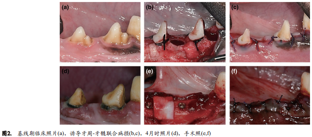 使用Bio-Oss骨胶原或联合使用胶原膜对于慢性感染拔牙窝的牙槽嵴保留效果