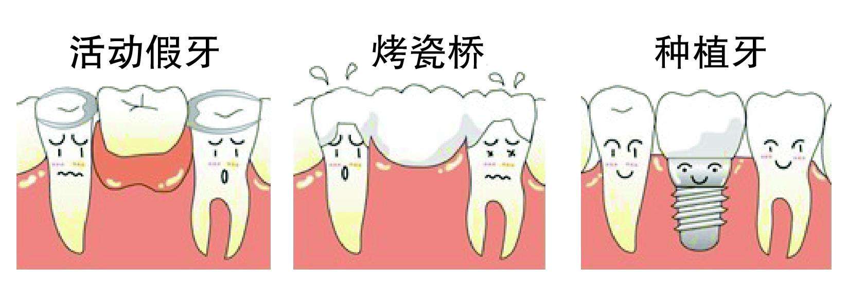 牙齿缺失三种修复方式
