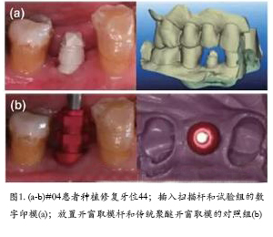 口腔种植临床研究
